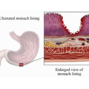  Biomedical Illustration Showing an Acute Gastric (Peptic 